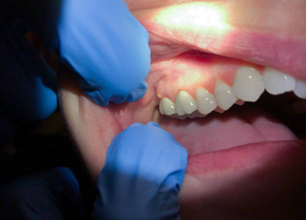 Best Emergency Dental Care for Broken or Chipped Teeth in Humansville, MO